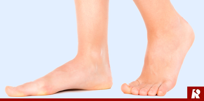 Adult Acquired Flat Feet