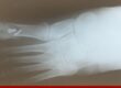 My Foot Surgery by Dr. Wayne A. Chieppa - Roxbury Foot and Ankle Center