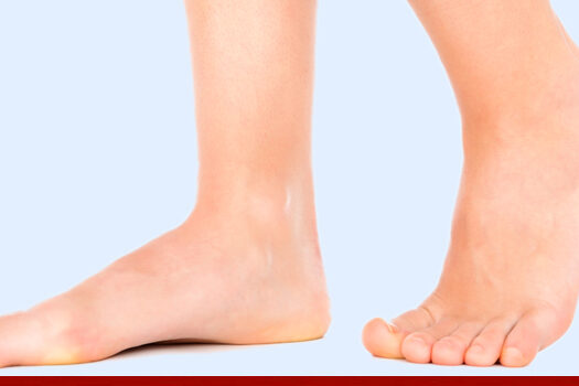 Treating Pediatric Flat Foot