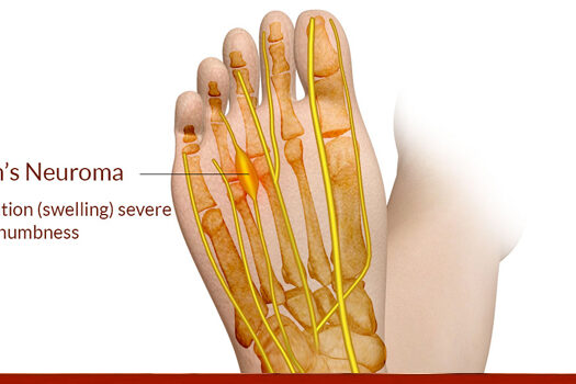 What Is Neuroma?