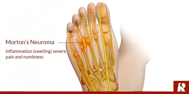 What Is Neuroma?